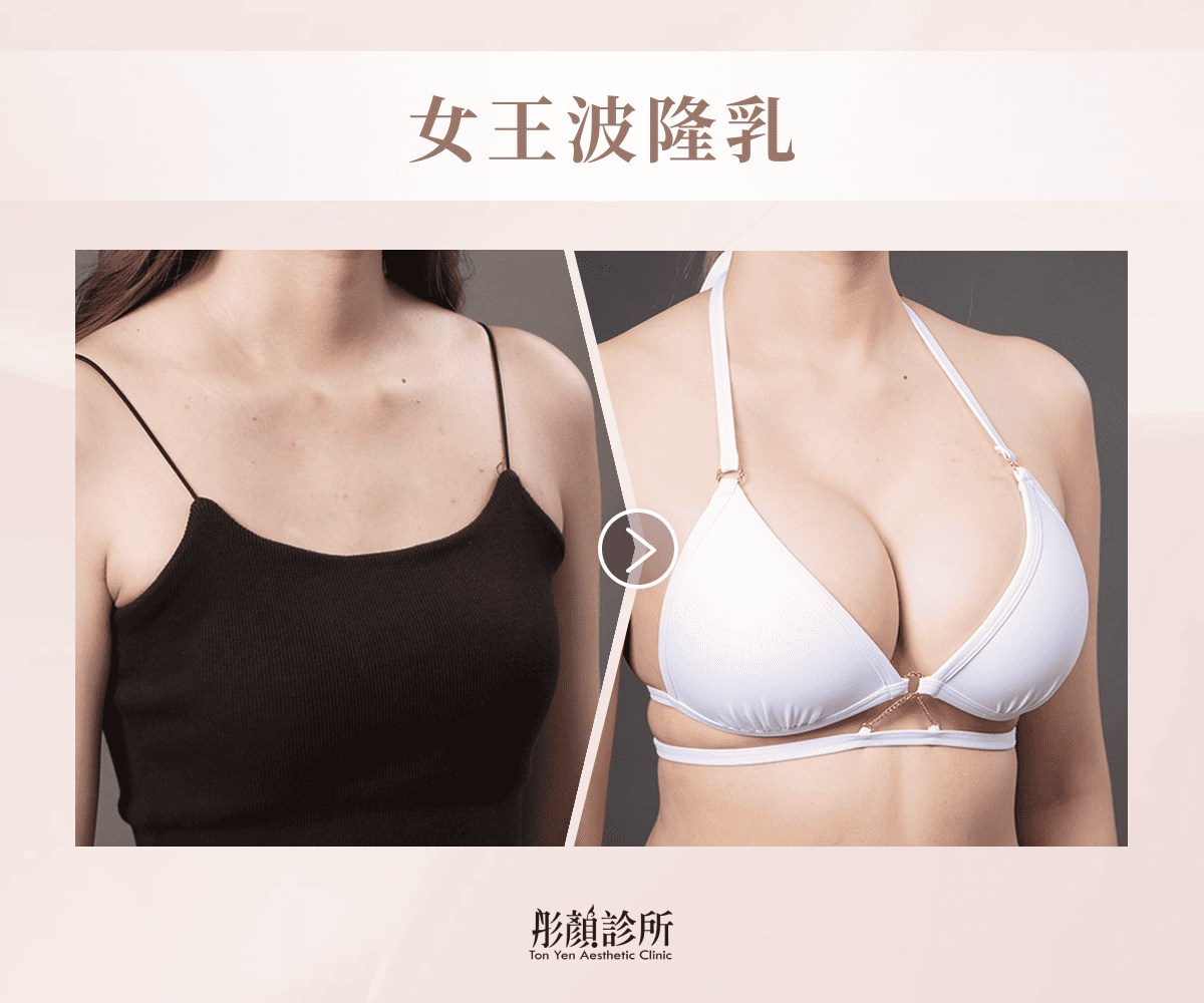 女王波隆乳案例二術前術後對比照