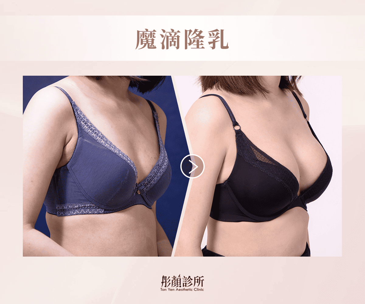 魔滴隆乳案例術前術後對比照