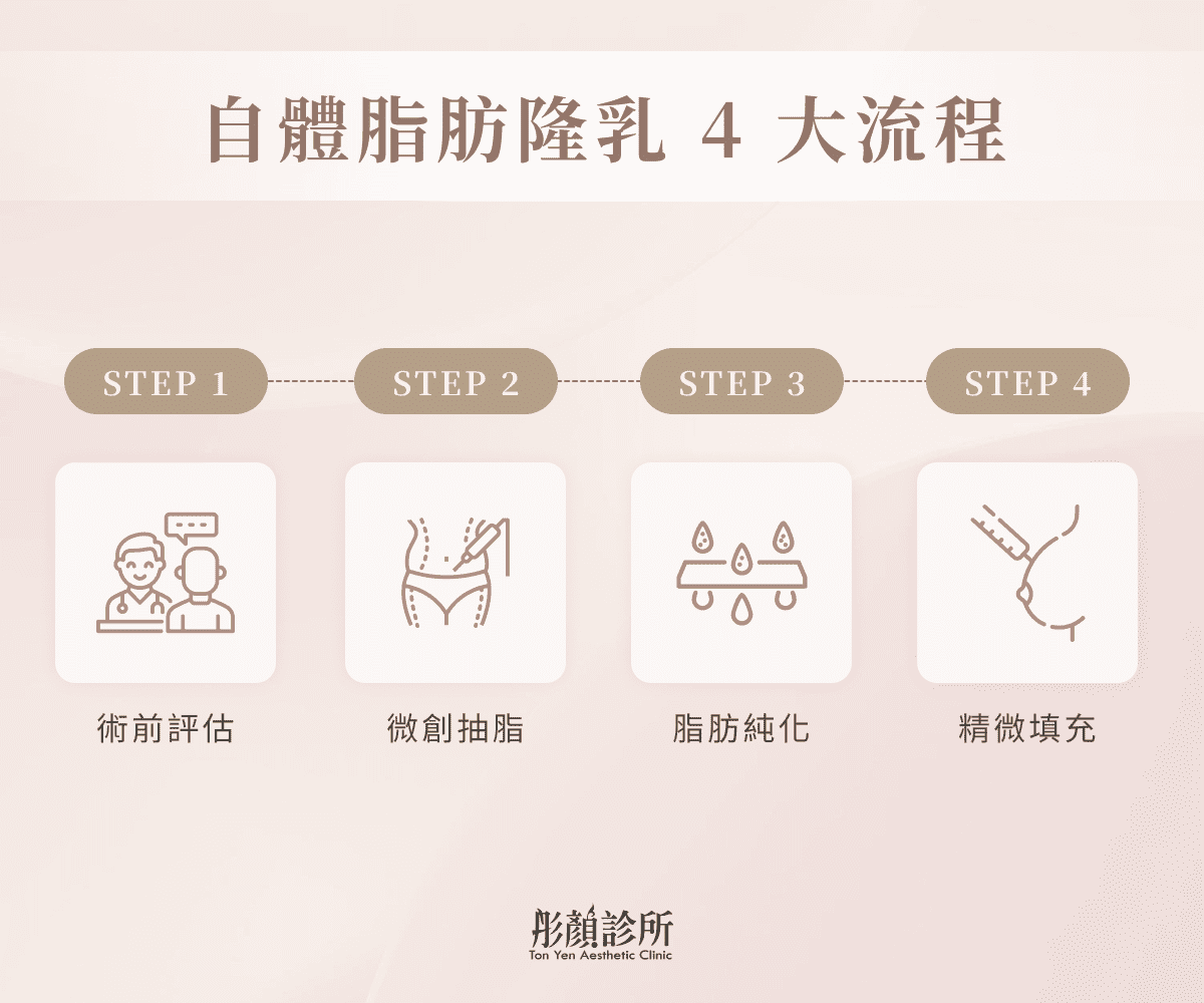 自體脂肪隆乳4大流程圖：術前評估、微創抽脂、脂肪純化、精微填充