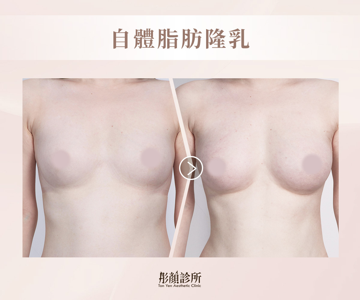 自體脂肪隆乳案例術前術後對比照
