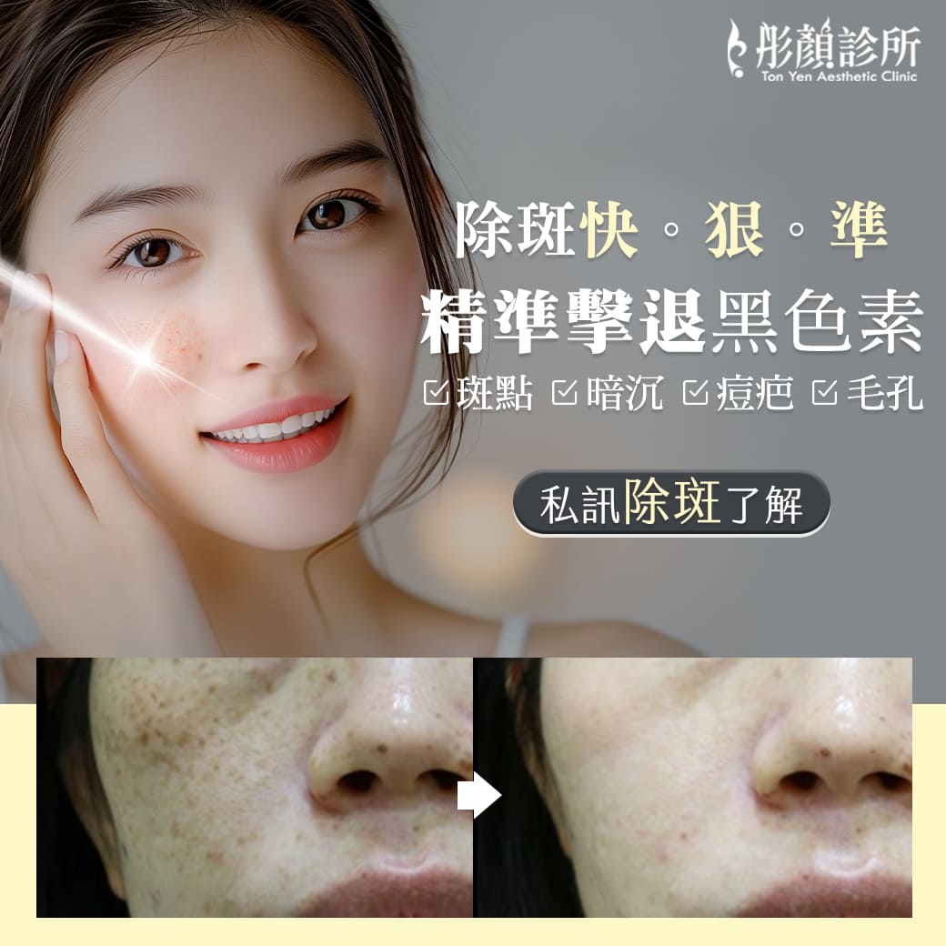 除斑-雷射除斑-肝斑-雀斑-複合式雷射-蜂巢皮秒雷射-有效除肝斑-肝斑治療推薦-肝斑如何去除-肝斑治療皮膚科-肝斑藥膏-彤顏診所-八德皮膚科-桃園皮膚科-中壢皮膚科-皮膚管理專家