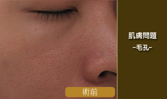 彤顏診所-毛孔粗大-毛孔老化-毛孔-皮膚管理專家-縮毛孔雷射前後比對效果-毛孔粗大改善-飛梭雷射-淨膚雷射