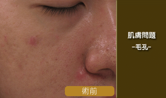 毛孔粗大前後效果-毛孔出油-縮毛孔-毛孔粗大改善-飛梭雷射-淨膚雷射