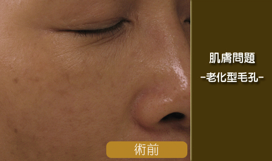 毛孔粗大-毛孔老化-出油問題-縮毛孔前後比對效果-蜂巢皮秒雷射-毛孔粗大改善-飛梭雷射-淨膚雷射