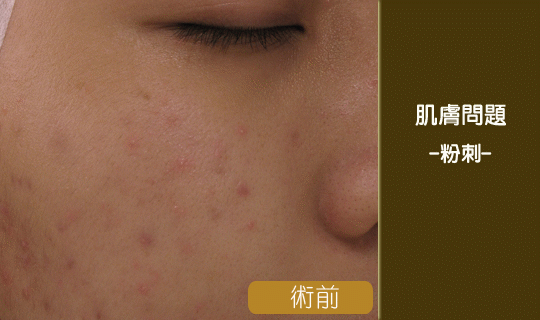 粉刺-清粉刺-醫美清粉刺前後對比-閉鎖性粉刺-黑頭粉刺-清粉刺推薦-毛孔清道夫-中壢清粉刺-桃園清粉刺