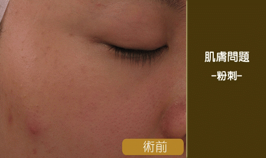 粉刺-粉刺清除-閉鎖性粉刺-黑頭粉刺-彤顏診所-中壢清粉刺-桃園清粉刺