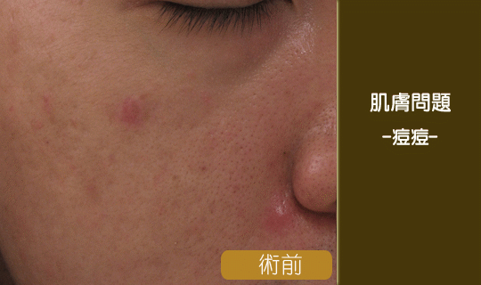 痘痘-粉刺-抗痘-毛孔-彤顏診所-痘痘治療-有效治療痘痘-皮膚科-八德彤顏診所-桃園彤顏診所