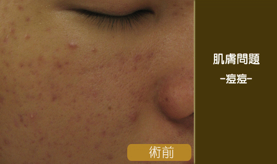 痘痘-粉刺-抗痘-毛孔-彤顏診所-痘痘治療-有效治療痘痘-皮膚科-八德彤顏診所-桃園彤顏診所