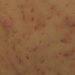 痘疤-中壢醫美-桃園醫美-八德醫美-林口醫美-彤顏診所-消除痘疤-黑痘疤-凹痘疤-紅痘疤