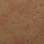 痘疤-中壢醫美-桃園醫美-八德醫美-林口醫美-彤顏診所-消除痘疤-黑痘疤-凹痘疤-紅痘疤