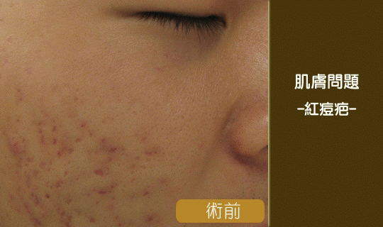 痘疤-中壢醫美-桃園醫美-八德醫美-林口醫美-彤顏診所-消除痘疤-黑痘疤-凹痘疤-紅痘疤