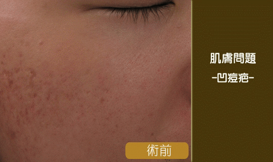 痘疤-中壢醫美-桃園醫美-八德醫美-林口醫美-彤顏診所-消除痘疤-黑痘疤-凹痘疤-紅痘疤