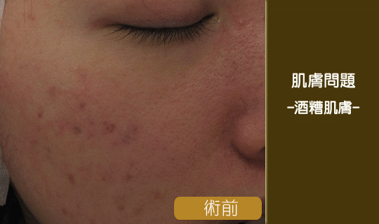 酒糟肌膚-泛紅-染料雷射-蠕形蟎蟲-敏感肌-酒糟丘疹