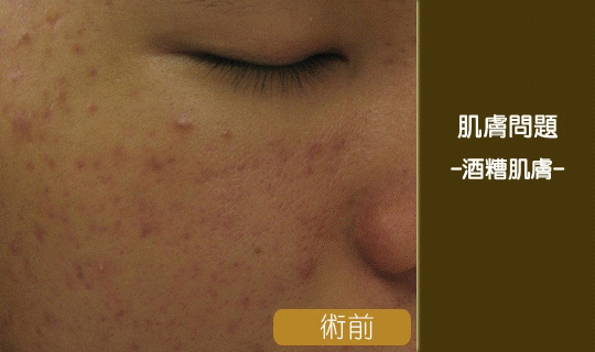 酒糟肌膚-泛紅-染料雷射-蠕形蟎蟲-敏感肌-酒糟丘疹