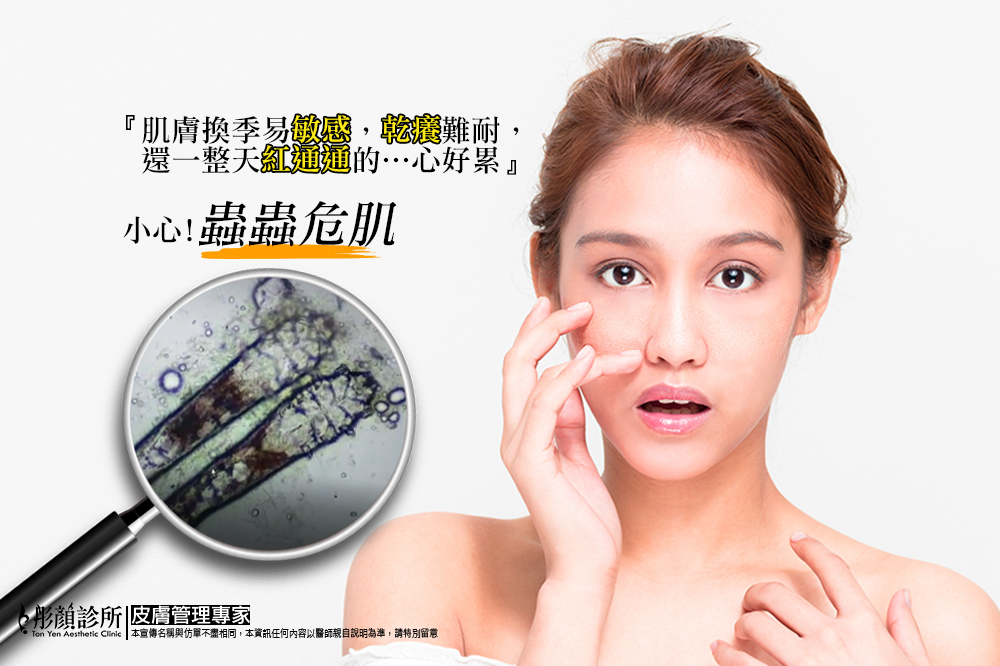 酒糟肌膚-泛紅-染料雷射-蠕形蟎蟲-敏感肌-酒糟丘疹