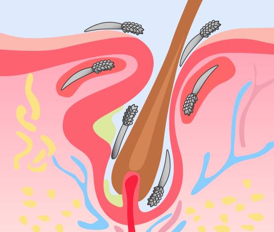 酒糟肌膚-泛紅-染料雷射-蠕形蟎蟲-敏感肌-酒糟丘疹