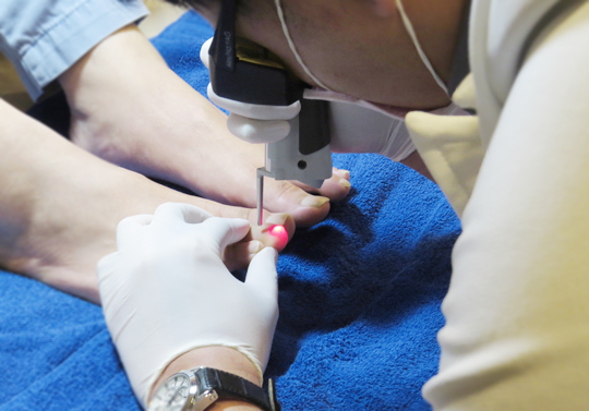 灰指甲-甲癬-指甲變色-指甲增厚變脆-甲床剝離-皮膚專科-皮膚管理專家-雷射治療灰指甲-灰指甲怎麼辦-灰指甲雷射-灰指甲治療方法