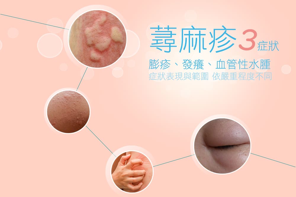 蕁麻疹-慢性蕁麻疹-減敏治療