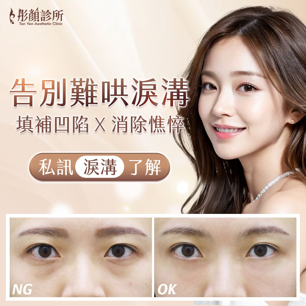 水微晶-玻尿酸-淚溝-法令紋-蘋果肌-墊下巴-玻尿酸價格-玻尿酸豐頰-藝術面雕－玻尿酸注射-玻尿酸推薦-玻尿酸下巴-玻尿酸法令紋-玻尿酸醫美-玻尿酸醫美推薦