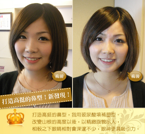 玻尿酸-水微晶-隆鼻-淚溝-法令紋-蘋果肌-墊下巴-玻尿酸價格-玻尿酸豐頰-喬雅登-凝膠式玻尿酸-藝術面雕