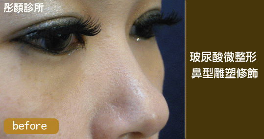 玻尿酸-水微晶-隆鼻-淚溝-法令紋-蘋果肌-墊下巴-豐唇-玻尿酸價格-玻尿酸豐頰-喬雅登-凝膠式玻尿酸-藝術面雕