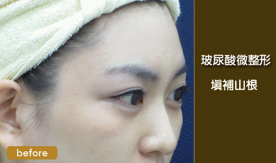 玻尿酸-水微晶-隆鼻-淚溝-法令紋-蘋果肌-墊下巴-豐唇-玻尿酸價格-玻尿酸豐頰-喬雅登-凝膠式玻尿酸-藝術面雕