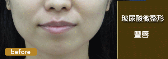 玻尿酸-水微晶-隆鼻-淚溝-法令紋-蘋果肌-墊下巴-豐唇-玻尿酸價格-玻尿酸豐頰-喬雅登-凝膠式玻尿酸-藝術面雕