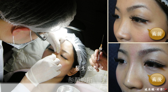 玻尿酸-水微晶-隆鼻-淚溝-法令紋-蘋果肌-墊下巴-玻尿酸價格-玻尿酸豐頰-喬雅登-凝膠式玻尿酸-藝術面雕