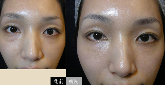 玻尿酸-水微晶-隆鼻-淚溝-法令紋-蘋果肌-墊下巴-玻尿酸價格-貴婦蘋果肌-玻尿酸豐頰-藝術面雕