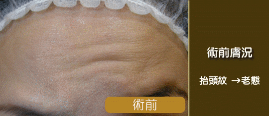 肉毒桿菌除皺-醫美除皺-抬頭紋肉毒除皺前後效果比對-魚尾紋-皺眉紋-肉毒-肉毒桿菌效果-肉毒除皺-肉毒桿菌價格