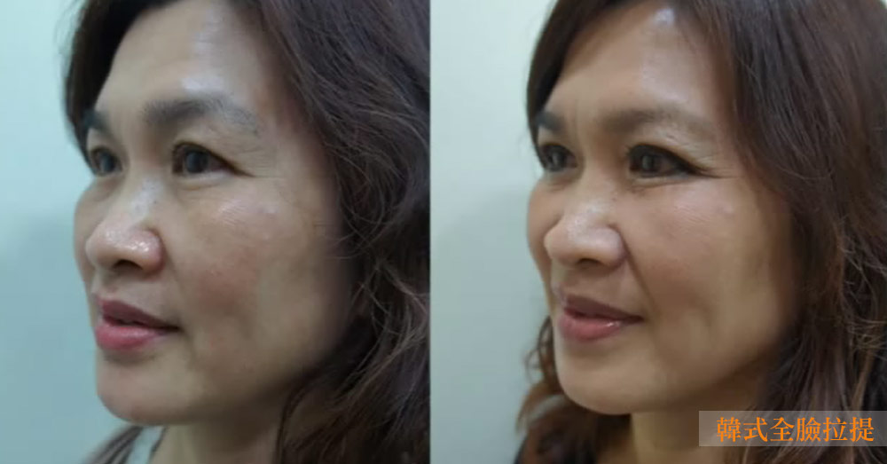 肉毒桿菌-除皺-瘦臉-瘦小腿-抬頭紋-魚尾紋-皺眉紋-肉毒-小臉-韓式肉毒拉提-韓式全臉拉提-肉毒桿菌效果-小臉肉毒-肉毒桿菌價格