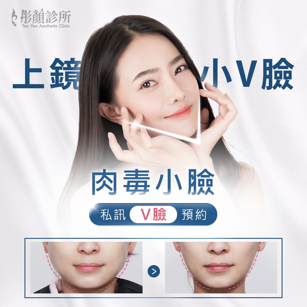 肉毒桿菌醫美-瘦小臉-肉毒桿菌瘦臉效果前後對比-肉毒-小臉-肉毒桿菌效果-肉毒桿菌價格-肉毒小臉價格