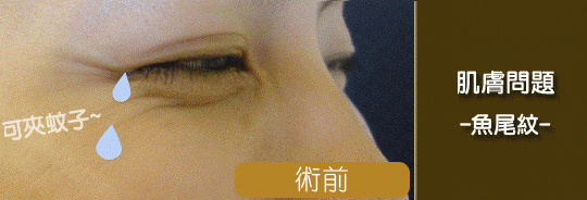 肉毒桿菌醫美-除皺醫美-抬頭紋醫美-魚尾紋肉毒除皺治療前後效果比對-皺眉紋-肉毒醫美-肉毒桿菌效果-肉毒桿菌價格