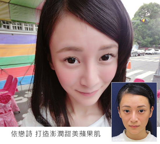 洢蓮絲-依戀詩-EllANSE-少女針-桃園醫美-洢蓮絲效果注射前後比較圖片