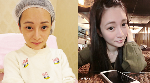 洢蓮絲效果-依戀詩效果-EllANSE-桃園醫美推薦