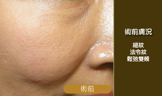 童顏針-童妍針-4D聚左旋乳酸術前術後比對照