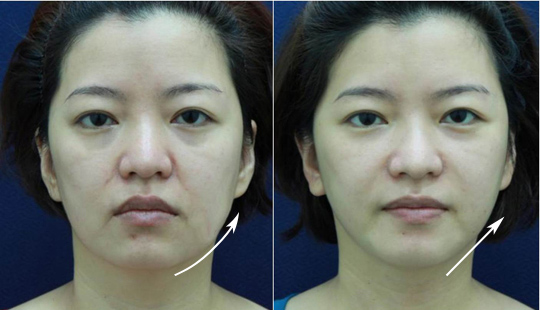 結構式線性拉提-線雕拉提-拉皮