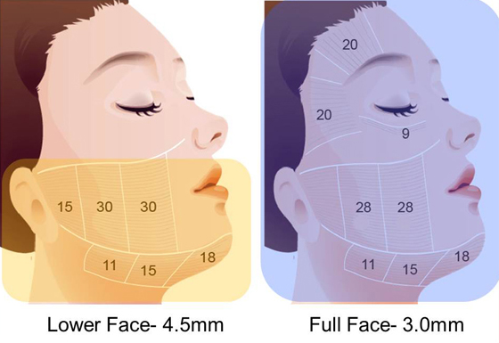 音波拉提-除皺-音波拉提下垂改善