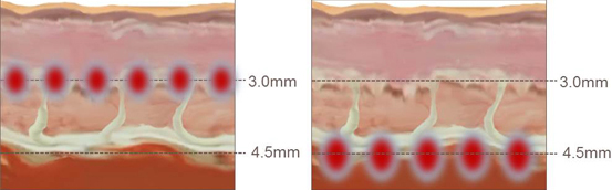 音波拉提-中壢音波拉提-桃園音波拉提-八德音波拉提-美國音波拉提-美國音波效果-音波拉提下垂改善