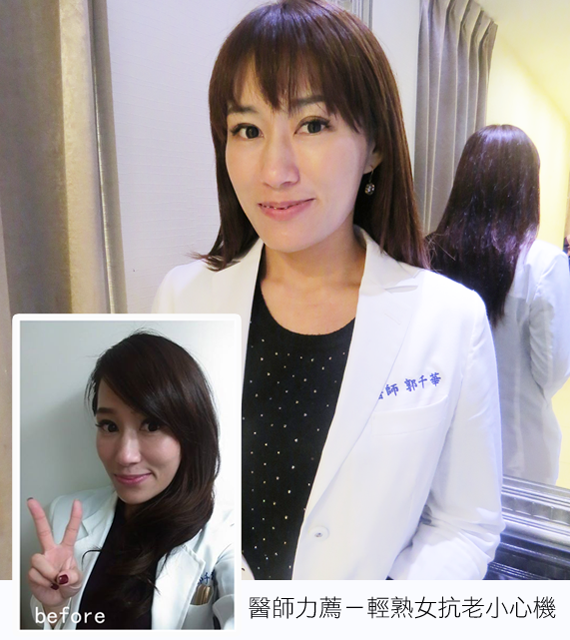 音波拉提-美國音波拉提-ulthera-極線音波拉提-美國音波拉提改善臉部鬆弛前後效果