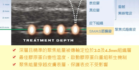 音波拉提-美國音波拉提