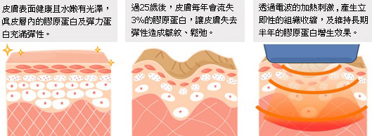 鳳凰電波-電波拉提費用-鳳凰電波拉提效果-鳳凰電波效果示意圖-電波拉提價格-桃園鳳凰電波推薦-中壢鳳凰電波推薦