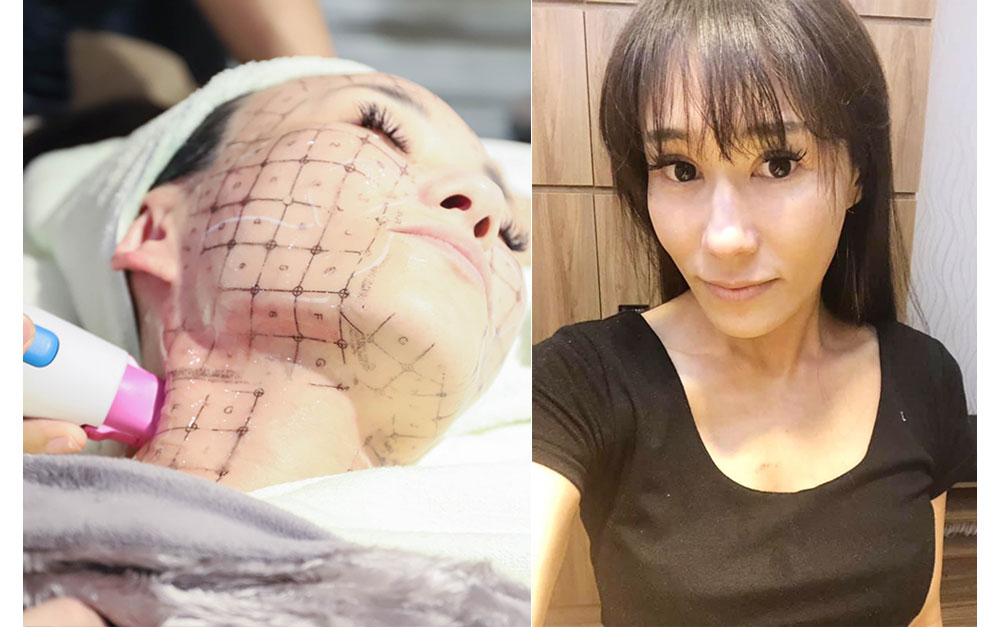 鳳凰電波-雙波拉提-中壢鳳凰電波-桃園鳳凰電波拉提-鳳凰電波前後對比效果-thermage flx-電音波-鳳凰電波拉提改善下垂肌膚