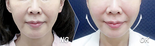 鳳凰電波-緊膚拉提-桃園鳳凰電波-鳳凰電波拉提價格-鳳凰電波效果-鳳凰電波拉提改善下垂肌膚-鳳凰電波前後對比效果