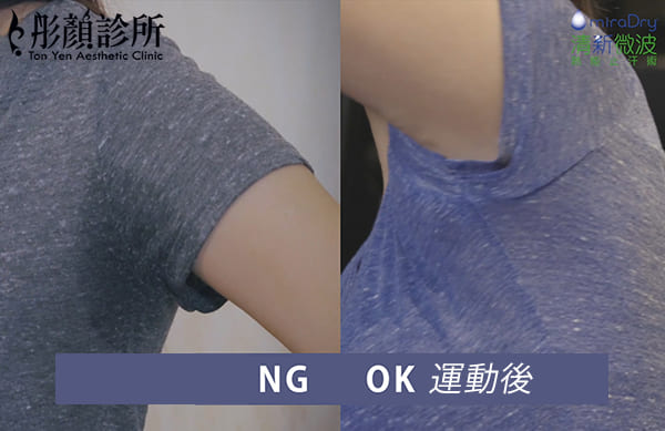 miraDry清新微波治療前後腋下乾爽對比照-狐臭治療-miradry-清新微波-miradry費用-miradry價錢-清新微波醫美推薦-miraDry效果