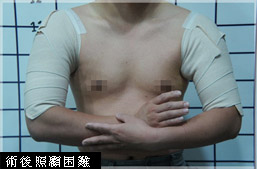 狐臭-汗腺發達-miradry-多汗-流汗-微舒淨-腋淨爽-旋轉刀