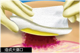 狐臭-汗腺發達-miradry-多汗-流汗-微舒淨-腋淨爽-頂漿腺刮除-汗腺切除