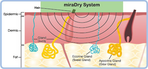 狐臭-清新微波-汗腺發達-miradry-多汗-流汗-微波熱能