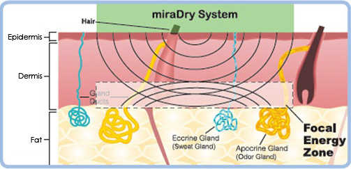 狐臭-汗腺發達-miradry-多汗-流汗-微波熱能