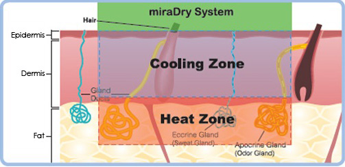 狐臭-清新微波-汗腺發達-miradry-多汗-miraDry治療-miraDry效果-miraDry狐臭-miraDry推薦